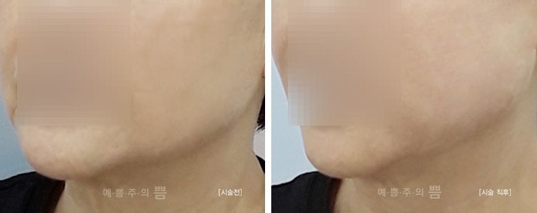 일산점_실리프팅