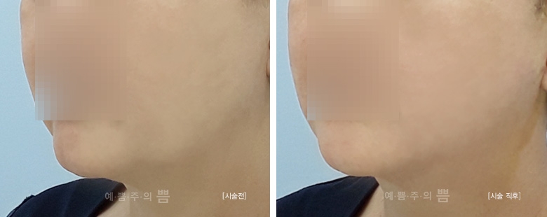 일산점_실리프팅